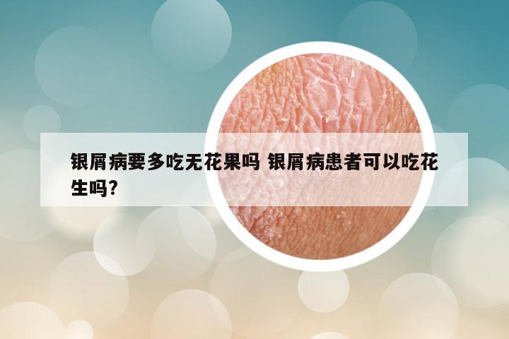 银屑病要多吃无花果吗 银屑病患者可以吃花生吗?