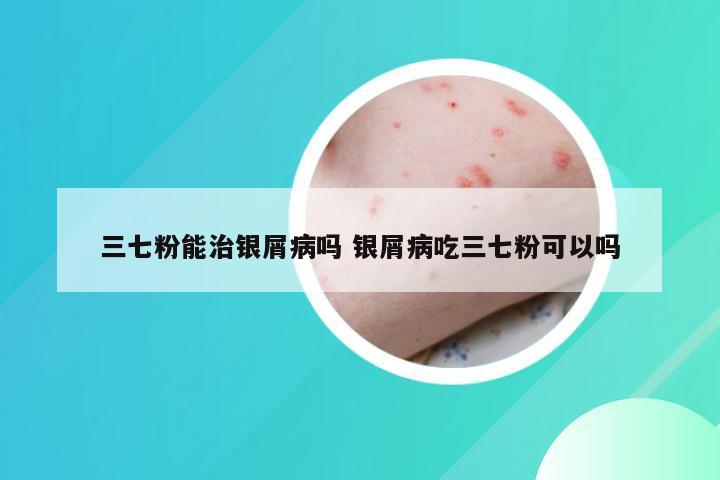 三七粉能治银屑病吗 银屑病吃三七粉可以吗