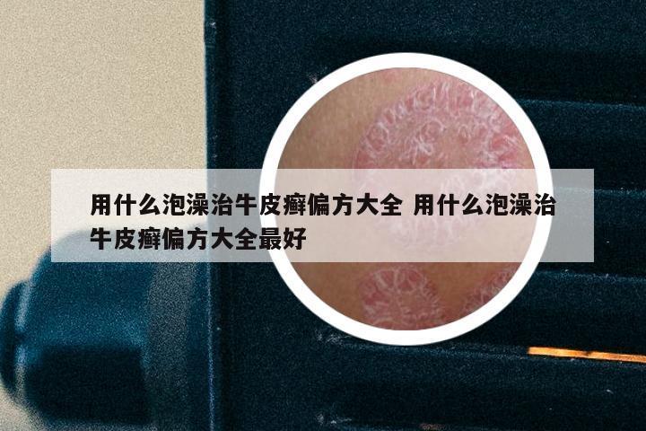 用什么泡澡治牛皮癣偏方大全 用什么泡澡治牛皮癣偏方大全最好