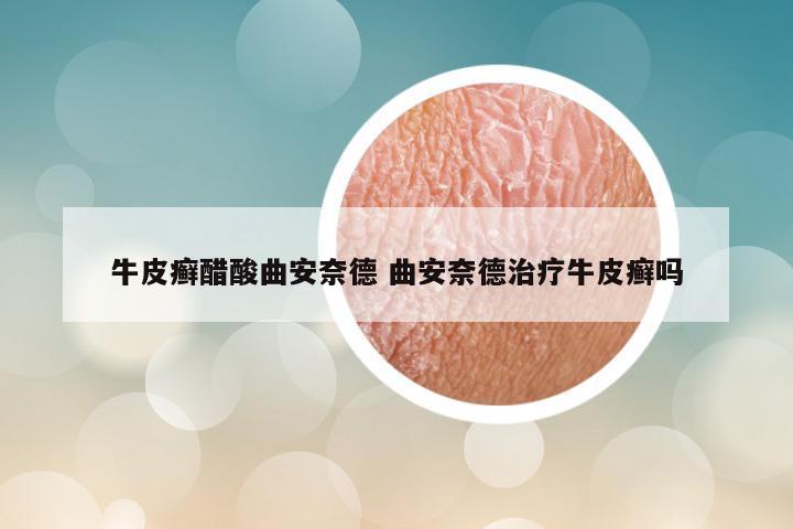 牛皮癣醋酸曲安奈德 曲安奈德治疗牛皮癣吗