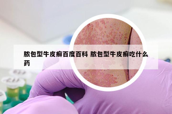 脓包型牛皮癣百度百科 脓包型牛皮癣吃什么药