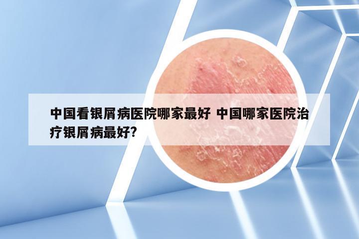 中国看银屑病医院哪家最好 中国哪家医院治疗银屑病最好?