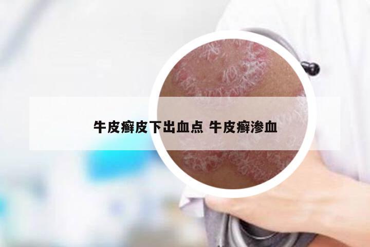 牛皮癣皮下出血点 牛皮癣渗血