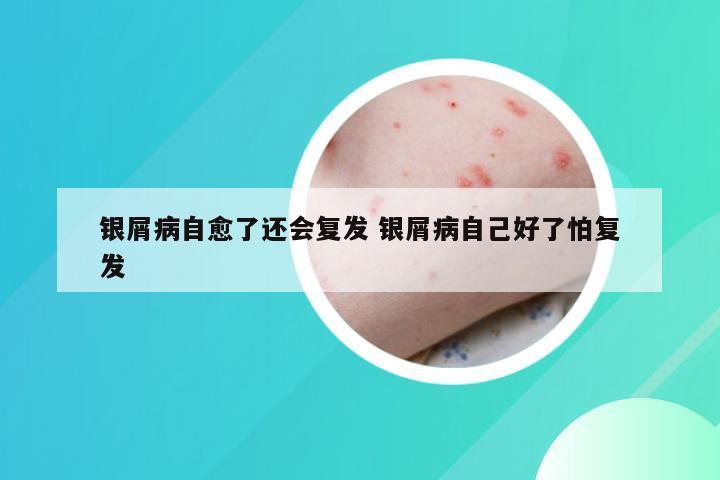 银屑病自愈了还会复发 银屑病自己好了怕复发