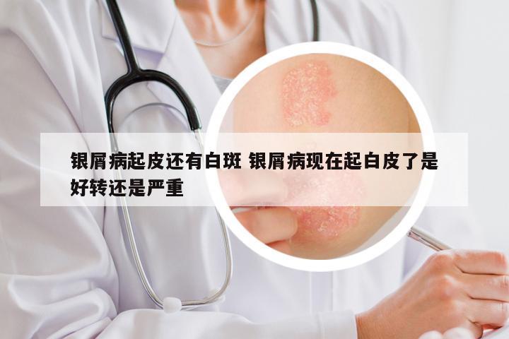 银屑病起皮还有白斑 银屑病现在起白皮了是好转还是严重