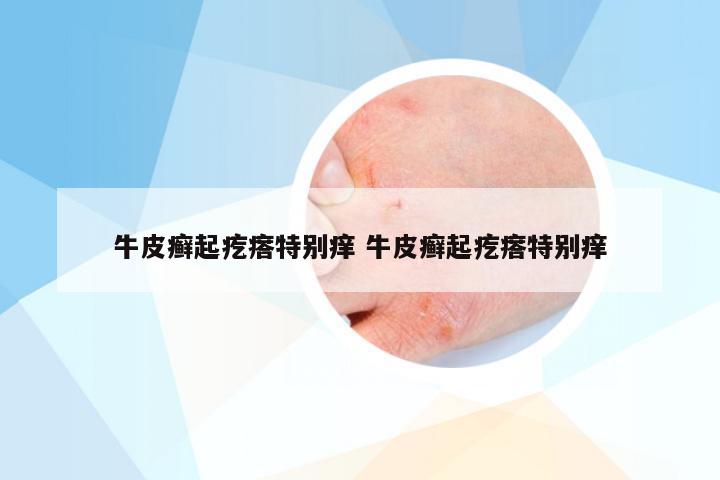 牛皮癣起疙瘩特别痒 牛皮癣起疙瘩特别痒