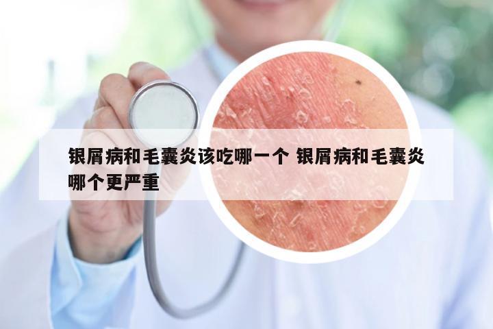 银屑病和毛囊炎该吃哪一个 银屑病和毛囊炎哪个更严重