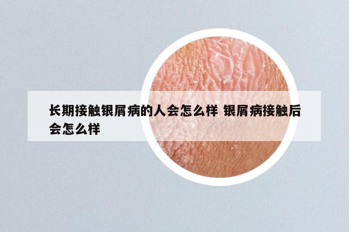 长期接触银屑病的人会怎么样 银屑病接触后会怎么样