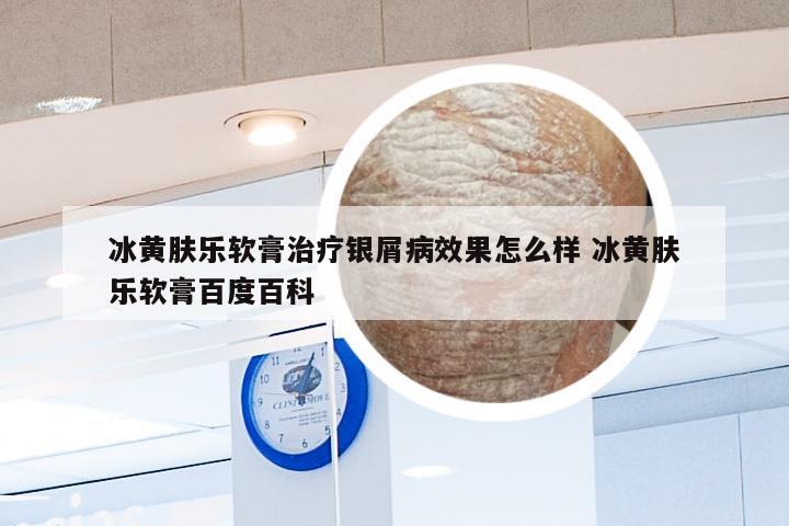冰黄肤乐软膏治疗银屑病效果怎么样 冰黄肤乐软膏百度百科