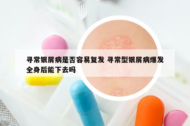 寻常银屑病是否容易复发 寻常型银屑病爆发全身后能下去吗