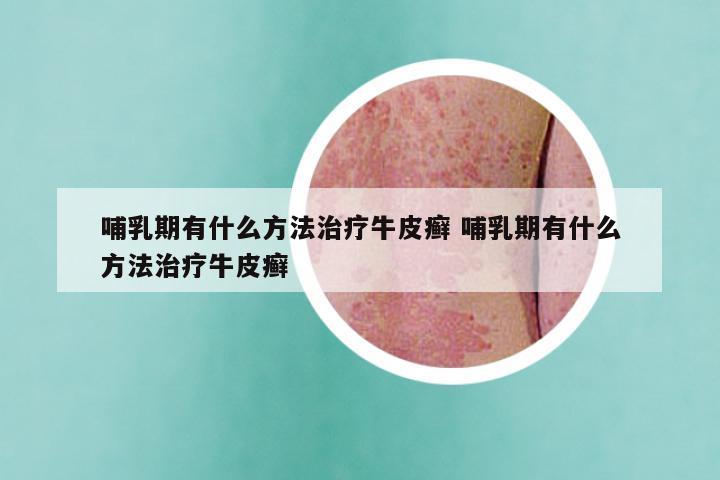 哺乳期有什么方法治疗牛皮癣 哺乳期有什么方法治疗牛皮癣