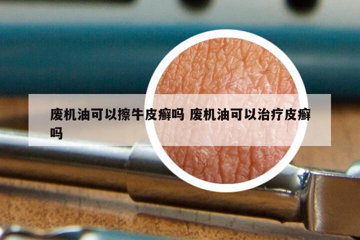 废机油可以擦牛皮癣吗 废机油可以治疗皮癣吗
