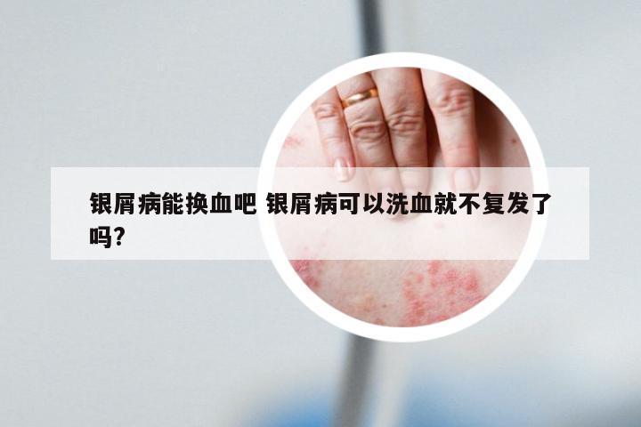 银屑病能换血吧 银屑病可以洗血就不复发了吗?