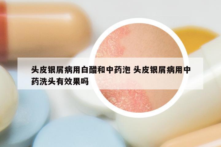 头皮银屑病用白醋和中药泡 头皮银屑病用中药洗头有效果吗