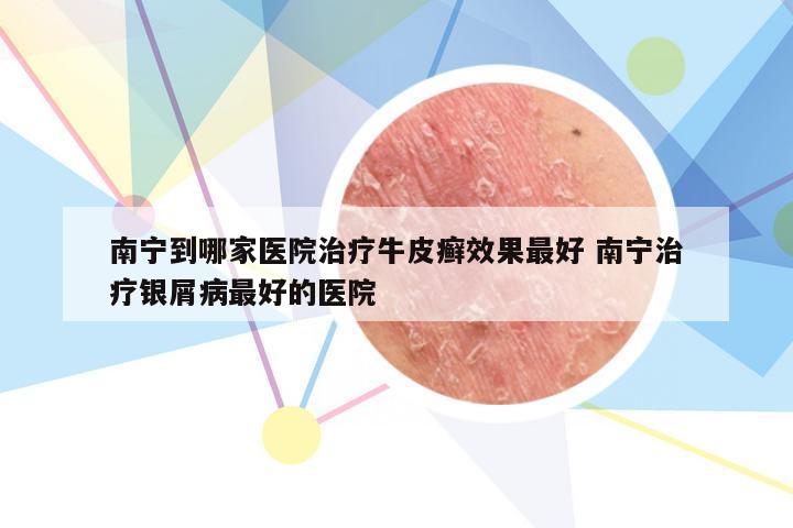 南宁到哪家医院治疗牛皮癣效果最好 南宁治疗银屑病最好的医院