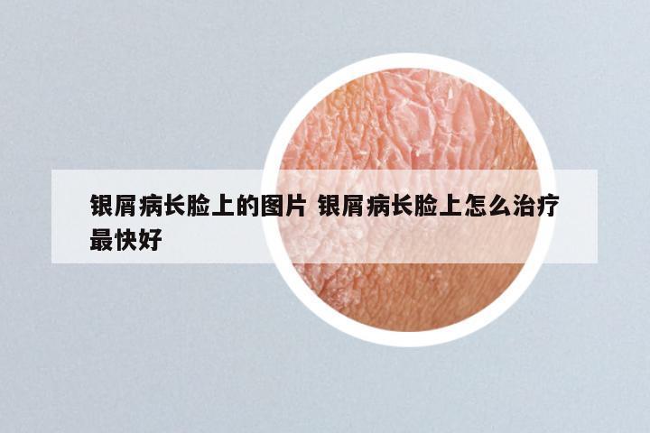 银屑病长脸上的图片 银屑病长脸上怎么治疗最快好