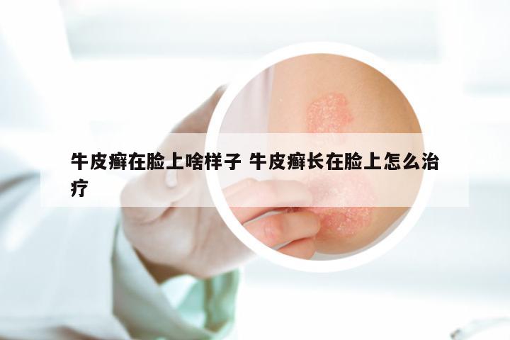牛皮癣在脸上啥样子 牛皮癣长在脸上怎么治疗
