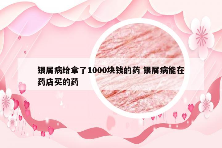 银屑病给拿了1000块钱的药 银屑病能在药店买的药
