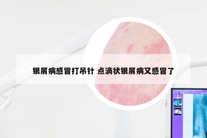 银屑病感冒打吊针 点滴状银屑病又感冒了