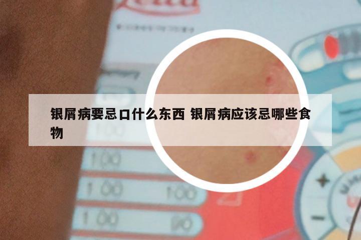 银屑病要忌口什么东西 银屑病应该忌哪些食物