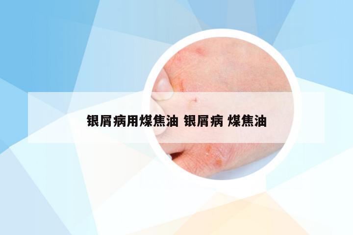 银屑病用煤焦油 银屑病 煤焦油