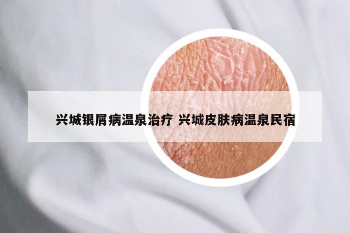 兴城银屑病温泉治疗 兴城皮肤病温泉民宿