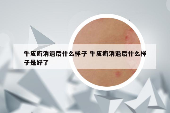 牛皮癣消退后什么样子 牛皮癣消退后什么样子是好了