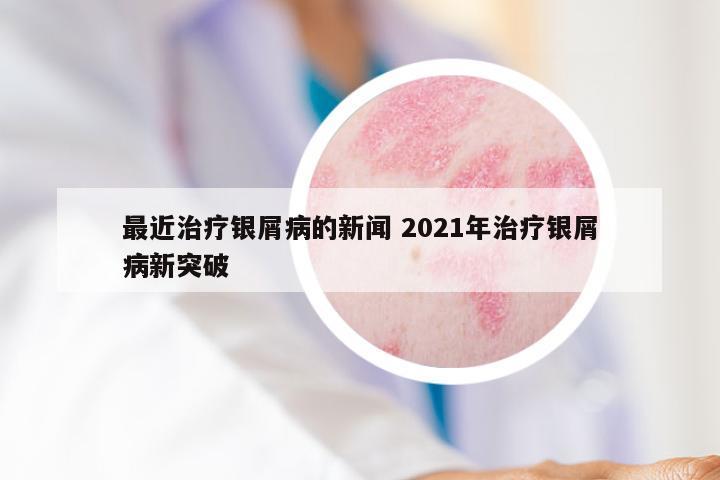 最近治疗银屑病的新闻 2021年治疗银屑病新突破