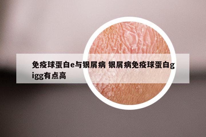 免疫球蛋白e与银屑病 银屑病免疫球蛋白gigg有点高