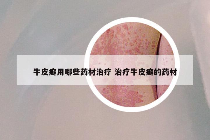 牛皮癣用哪些药材治疗 治疗牛皮癣的药材