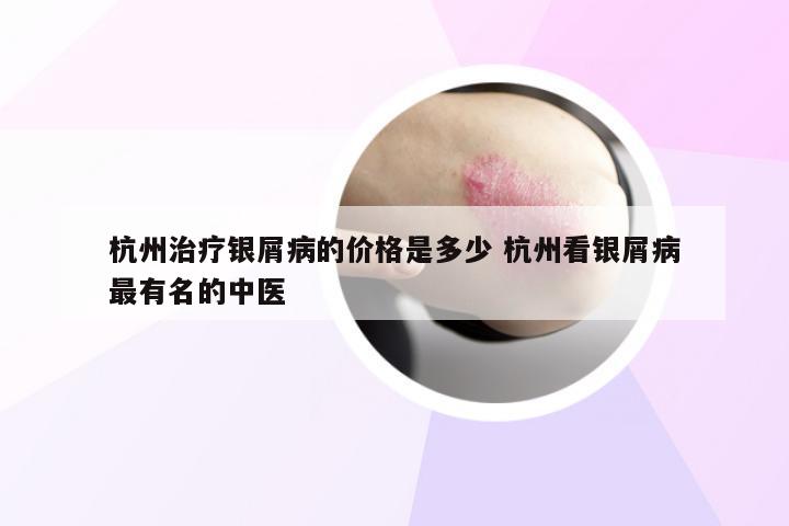 杭州治疗银屑病的价格是多少 杭州看银屑病最有名的中医
