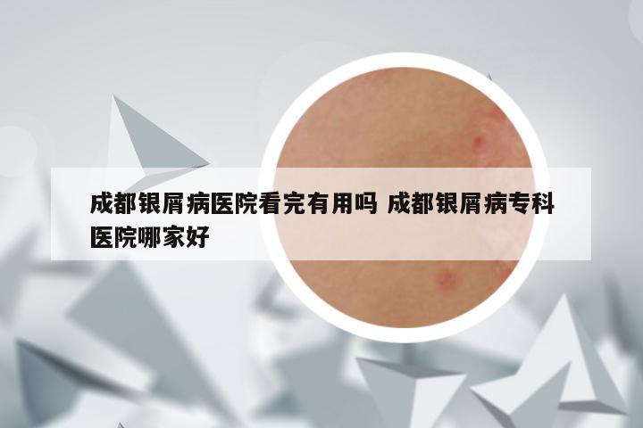 成都银屑病医院看完有用吗 成都银屑病专科医院哪家好