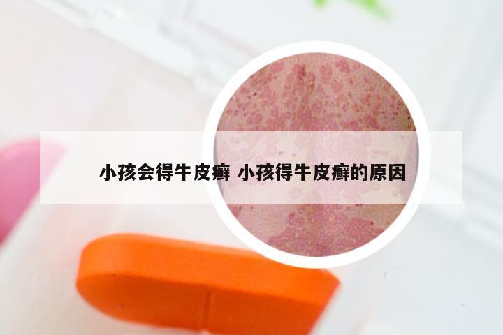 小孩会得牛皮癣 小孩得牛皮癣的原因