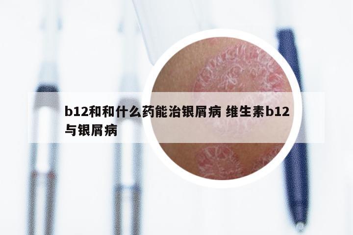 b12和和什么药能治银屑病 维生素b12与银屑病