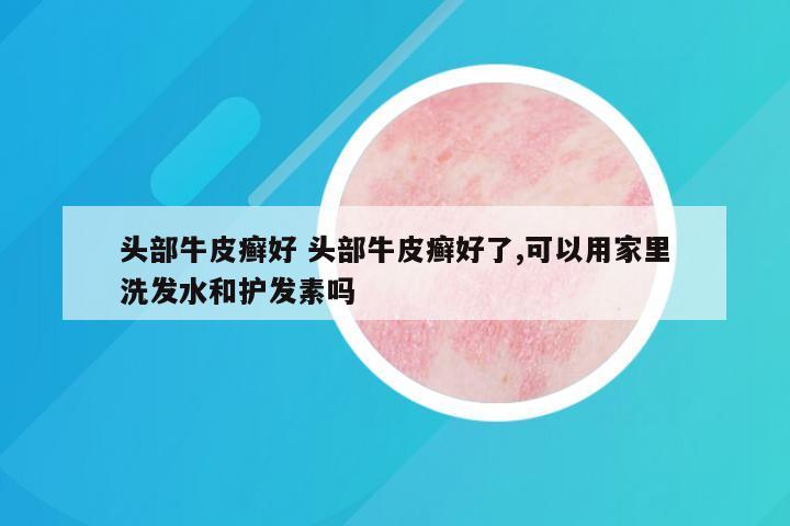 头部牛皮癣好 头部牛皮癣好了,可以用家里洗发水和护发素吗