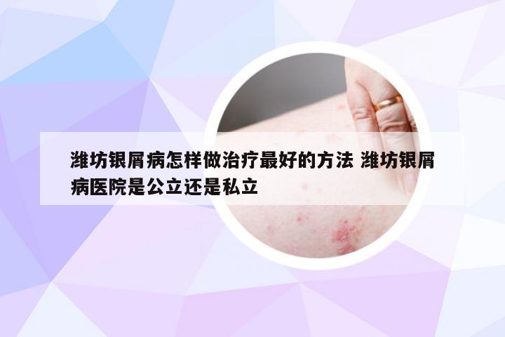 潍坊银屑病怎样做治疗最好的方法 潍坊银屑病医院是公立还是私立