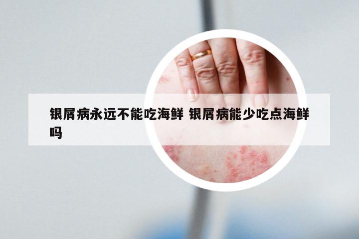 银屑病永远不能吃海鲜 银屑病能少吃点海鲜吗