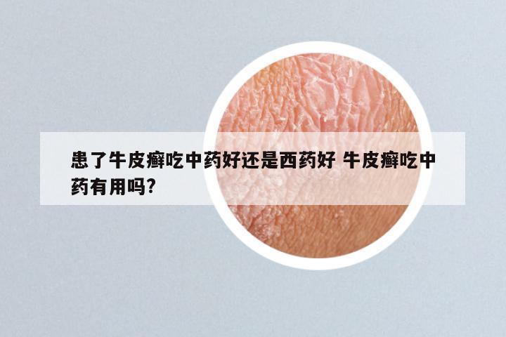 患了牛皮癣吃中药好还是西药好 牛皮癣吃中药有用吗?