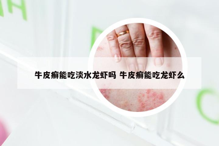 牛皮癣能吃淡水龙虾吗 牛皮癣能吃龙虾么