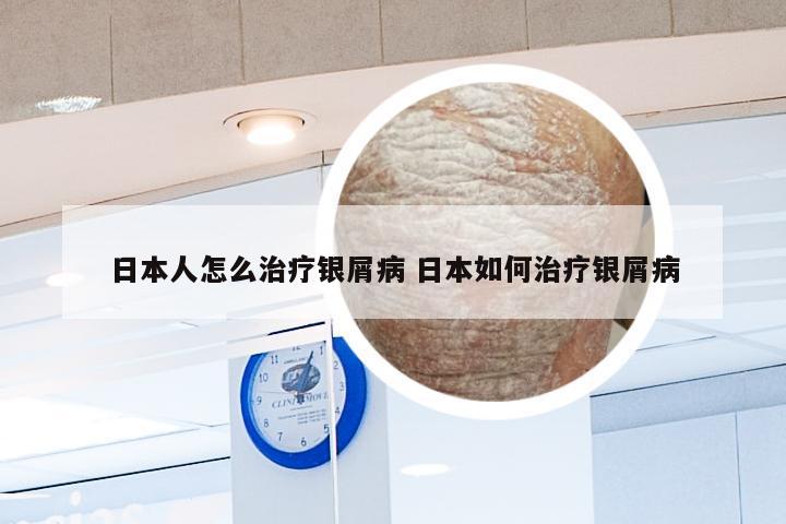 日本人怎么治疗银屑病 日本如何治疗银屑病