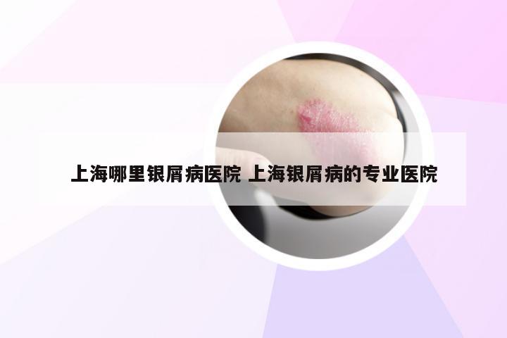 上海哪里银屑病医院 上海银屑病的专业医院