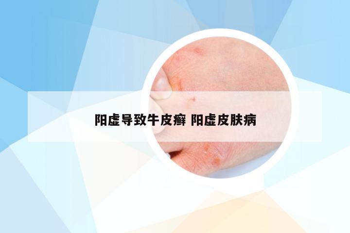 阳虚导致牛皮癣 阳虚皮肤病