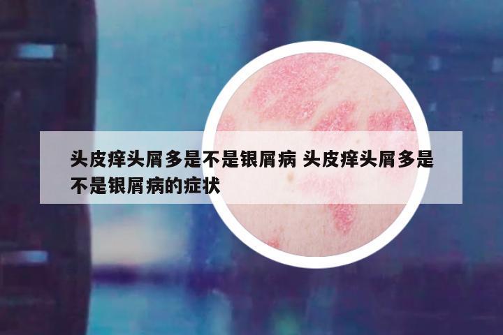 头皮痒头屑多是不是银屑病 头皮痒头屑多是不是银屑病的症状