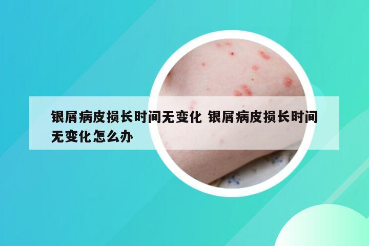 银屑病皮损长时间无变化 银屑病皮损长时间无变化怎么办