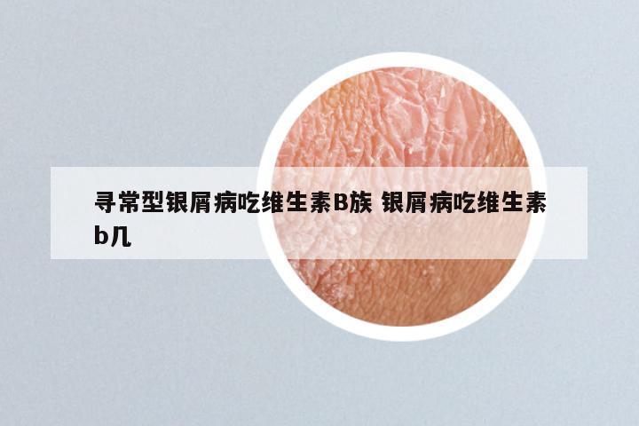寻常型银屑病吃维生素B族 银屑病吃维生素b几
