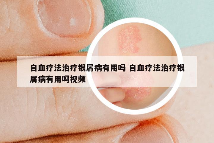 自血疗法治疗银屑病有用吗 自血疗法治疗银屑病有用吗视频