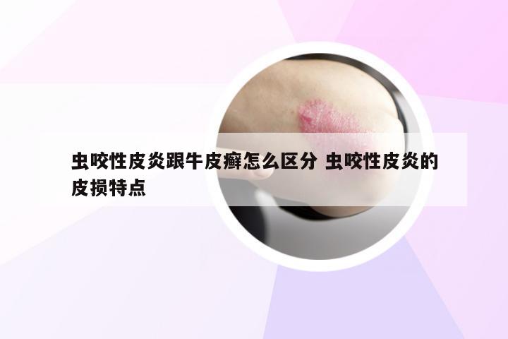 虫咬性皮炎跟牛皮癣怎么区分 虫咬性皮炎的皮损特点