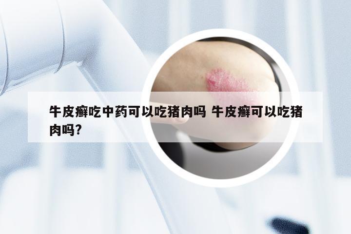 牛皮癣吃中药可以吃猪肉吗 牛皮癣可以吃猪肉吗?