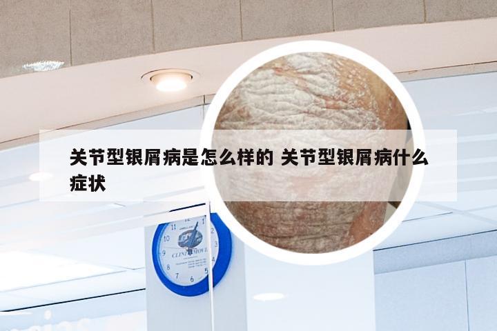 关节型银屑病是怎么样的 关节型银屑病什么症状