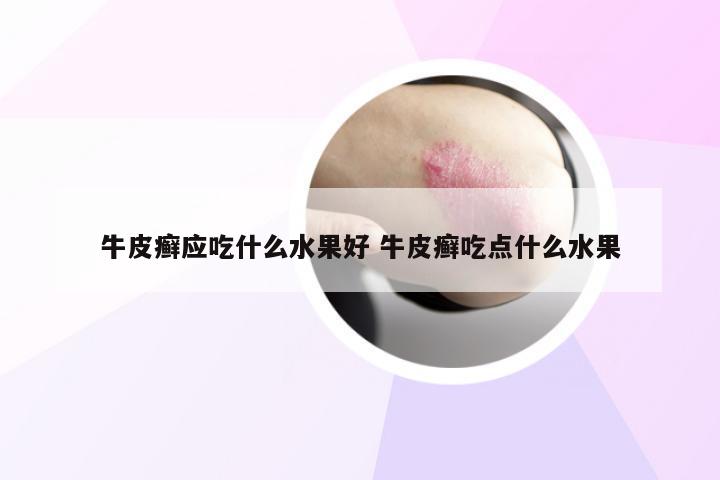 牛皮癣应吃什么水果好 牛皮癣吃点什么水果